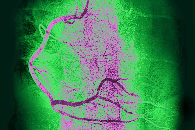 New Research Reveals Who May Benefit Most From a Heart Calcium Scan Post